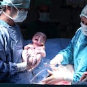 Parto por cesárea en el quirófano