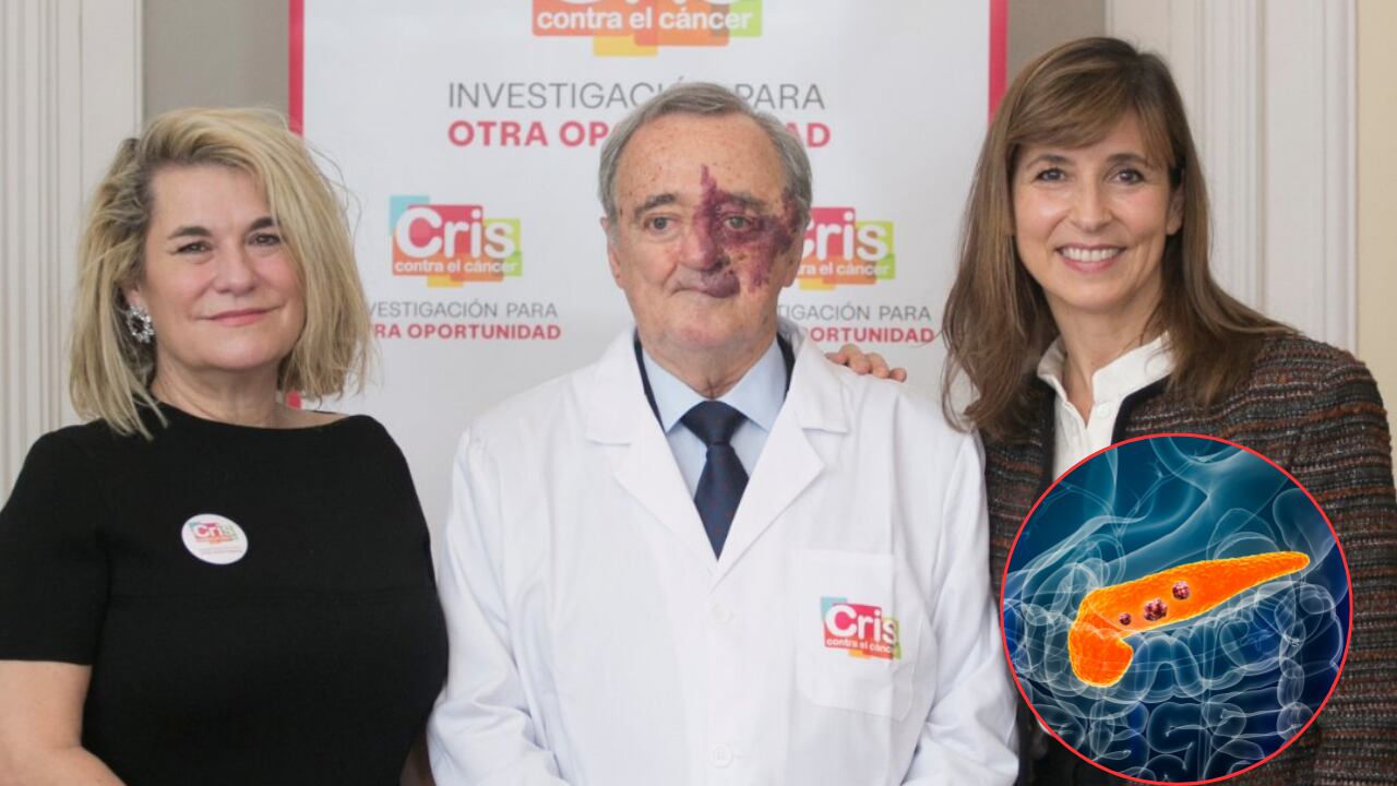 La combinación de varios medicamentos mostró resultados inéditos frente al cáncer de páncreas.