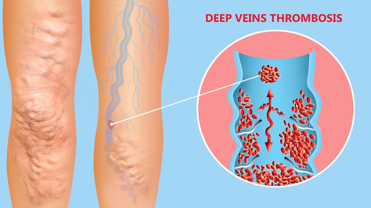Los trombos se generan por coágulos de sangre que taponan las arterias.