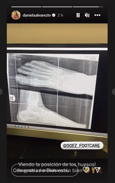 Daniella Álvarez mostró que los huesos de su píe derecho están bien
