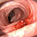 El cáncer de colon es una enfermedad común.