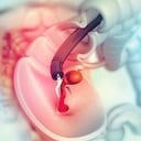 cáncer de colon. colonoscopio en el colon. eliminación de pólipos. ilustración 3d