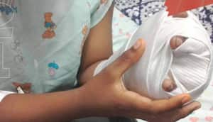 Niño quemado con pólvora en estas fiestas decembrina.