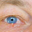 A cualquier persona le puede salir un orzuelo. (Photo By BSIP/UIG Via Getty Images)