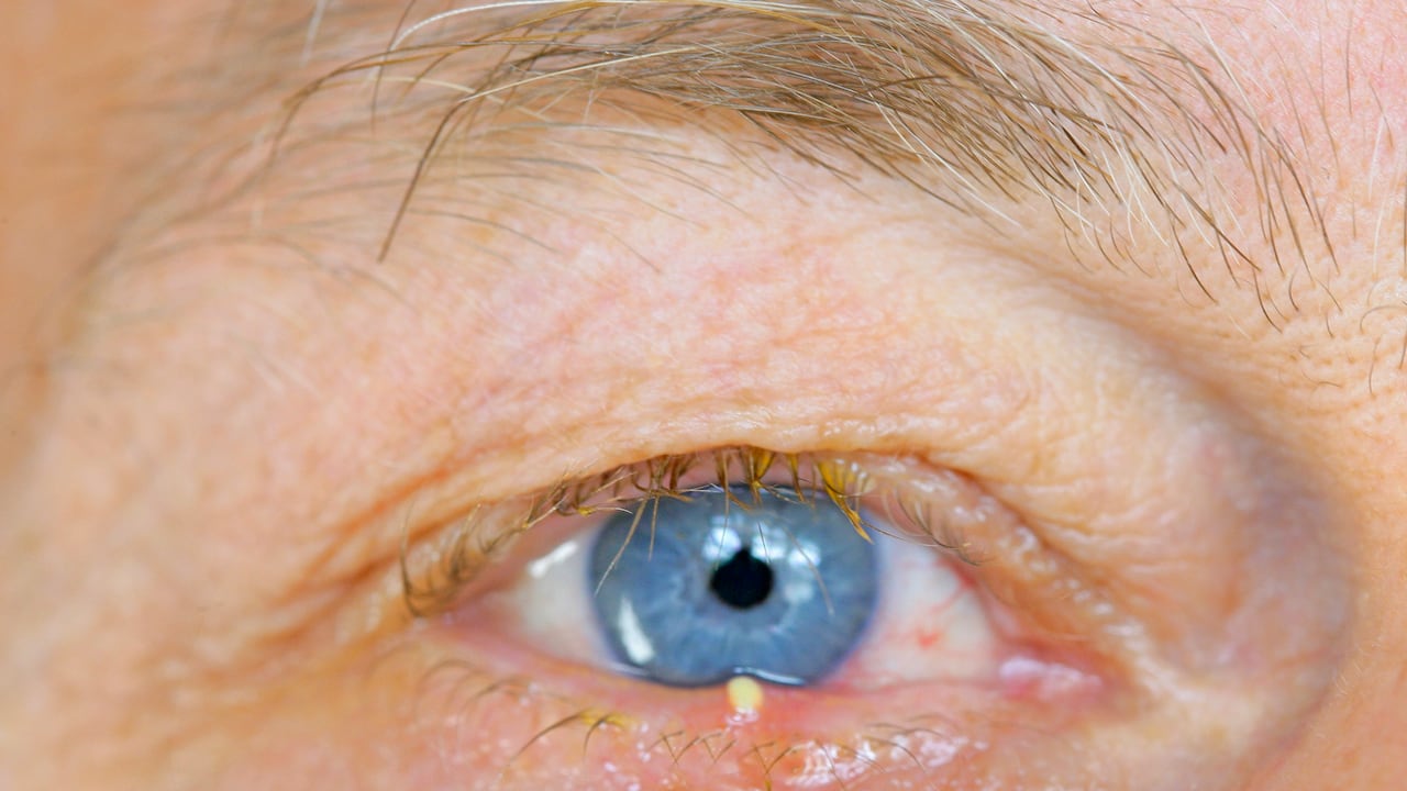 A cualquier persona le puede salir un orzuelo. (Photo By BSIP/UIG Via Getty Images)
