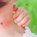 Las picaduras de mosquitos afectan más a unas personas que a otras.