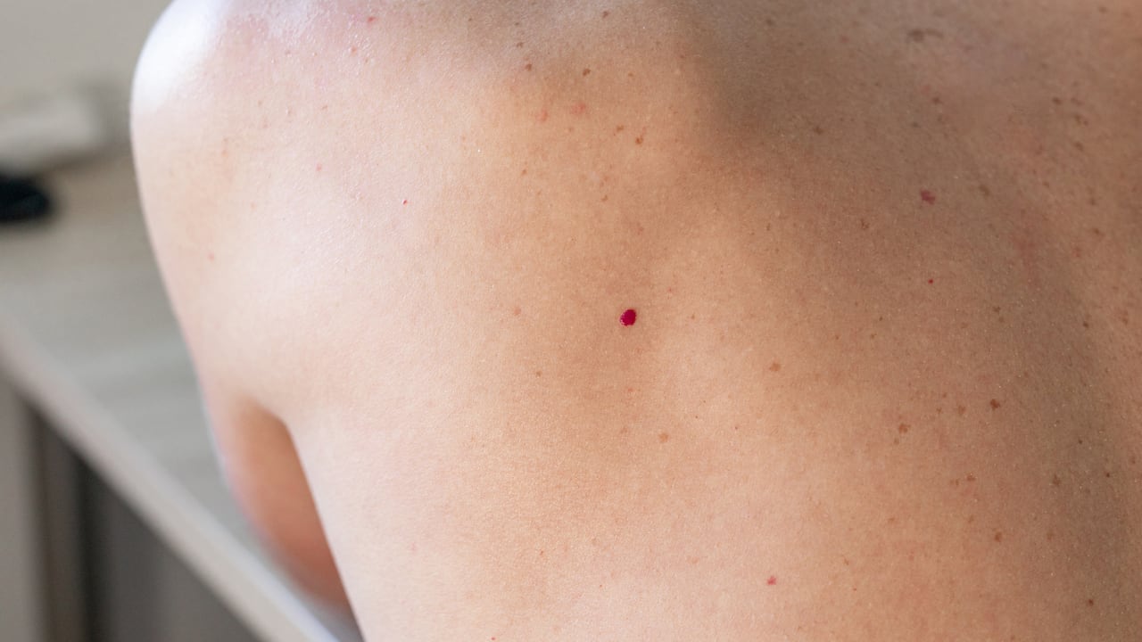 Lunares rojos, lunar rojo, cuidado de la piel, espalda.