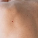 Lunares rojos, lunar rojo, cuidado de la piel, espalda.