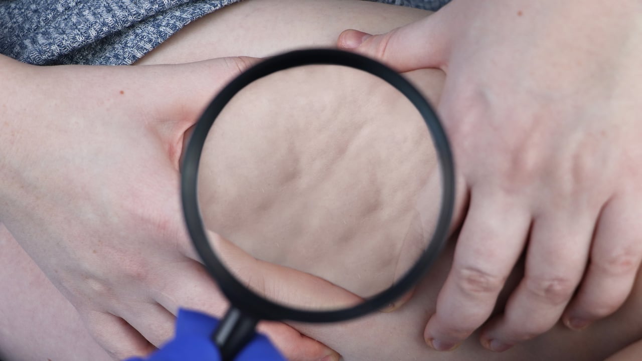 La celulitis se nota más con el sobrepeso.