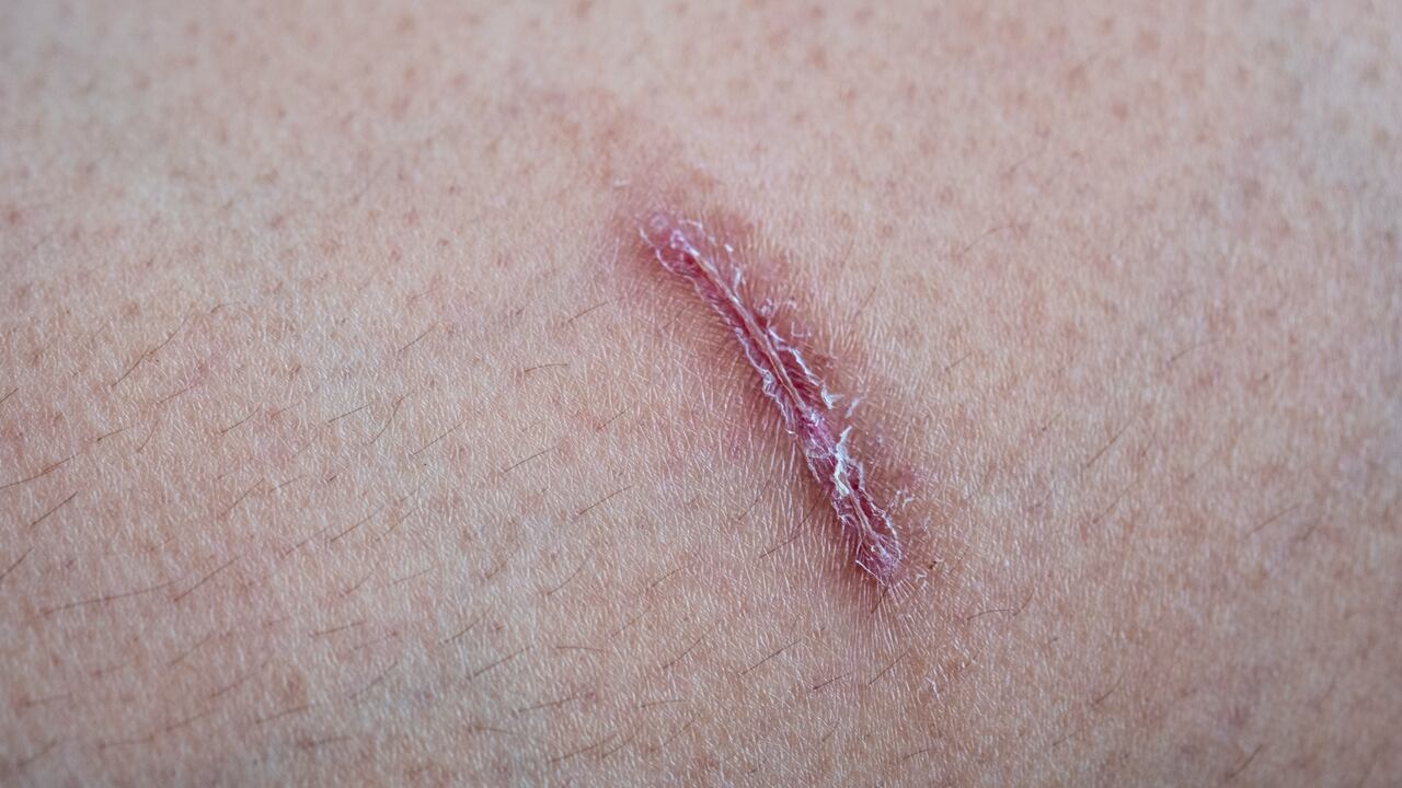 La vitamina C participa en el proceso de cicatrización.