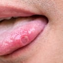 Lengua con úlceras de hombre adulto.