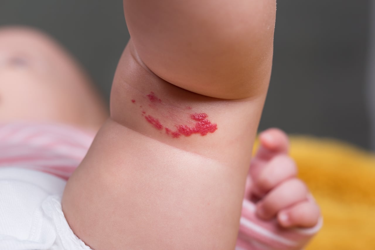 Angioma