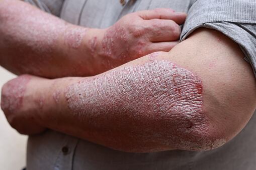 La neurodermatitis es una condición que compromete la salud de la piel; el cual causa grandes molestias para quien la sufre.