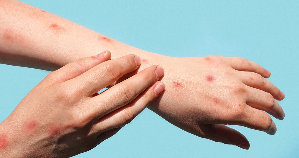 La OMS advirtió que en la última semana el número de casos en el mundo aumentó 77 por ciento. 