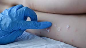 La viruela del mono es la nueva enfermedad que tiene en alerta a la OMS. Esto es lo que se sabe del virus.