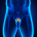 El cáncer de próstata es uno de los que más afecta a los hombres.