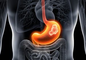 El cáncer de estómago normalmente se manifiesta cin síntomas cuando ya está avanzado.