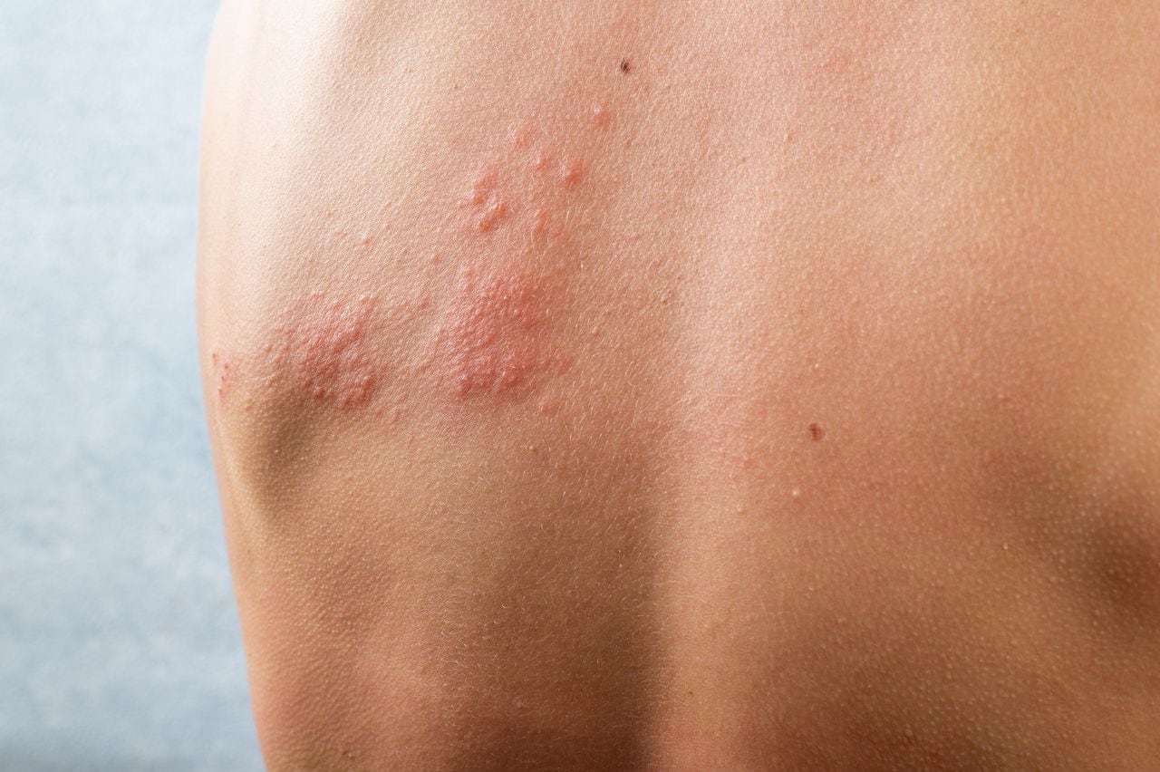 Herpes zóster infectando la piel