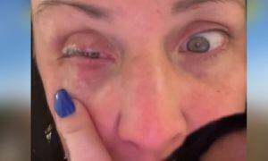 Mujer aplicó accidentalmente en su ojo pegamento para uñas pensando que era gotas oculares