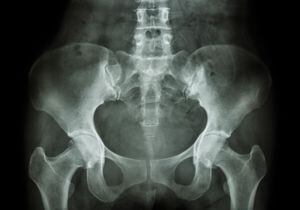 Radiografía de pelvis