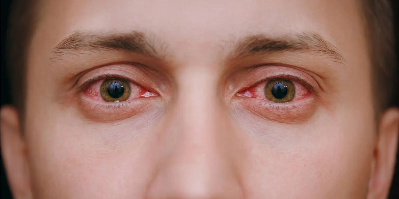Los ojos rojos es uno de los síntomas más comunes que presentan los adictos al cannabis y otras sustancias.