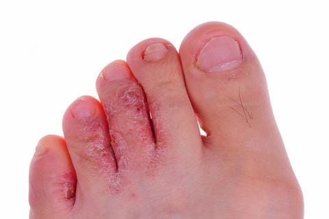 Los hongos en las uñas pueden aparecer por no usar zapatos adecuados en lugares públicos.