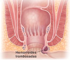 Hemorroides trombosadas