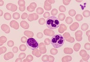 El leucocito de la izquierda con un núcleo ovalado es un linfocito, una importante célula inmunitaria. Los dos leucocitos a la derecha del linfocito son los neutrófilos. Por lo general, tienen un núcleo segmentado o lobulado. Los neutrófilos son excelentes células fagocíticas que engullen partículas o microorganismos dañinos. Los Trombocitos están en la esquina superior derecha, son muy importantes en la trombosis o coagulación de la sangre. Las células teñidas de rosa son eritrocitos, carecen de núcleo, de ahí la palidez central, contienen grandes cantidades de moléculas de hemoglobina y transportan oxígeno. Este es un frotis de sangre normal usando la tinción de Wright.