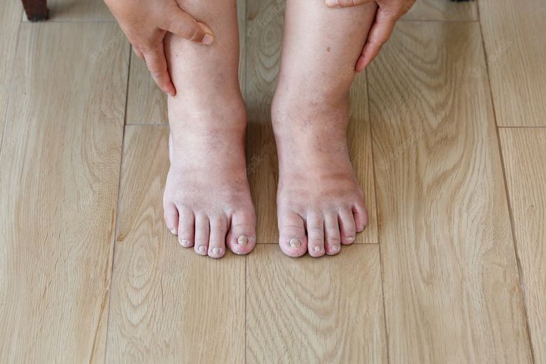 Swelling In The Legs And Feet Affects The Treatment Of Hypotension.  Therefore, Doctors Recommend Using Special Stockings So That The Blood Circulates And Regulates Itself.