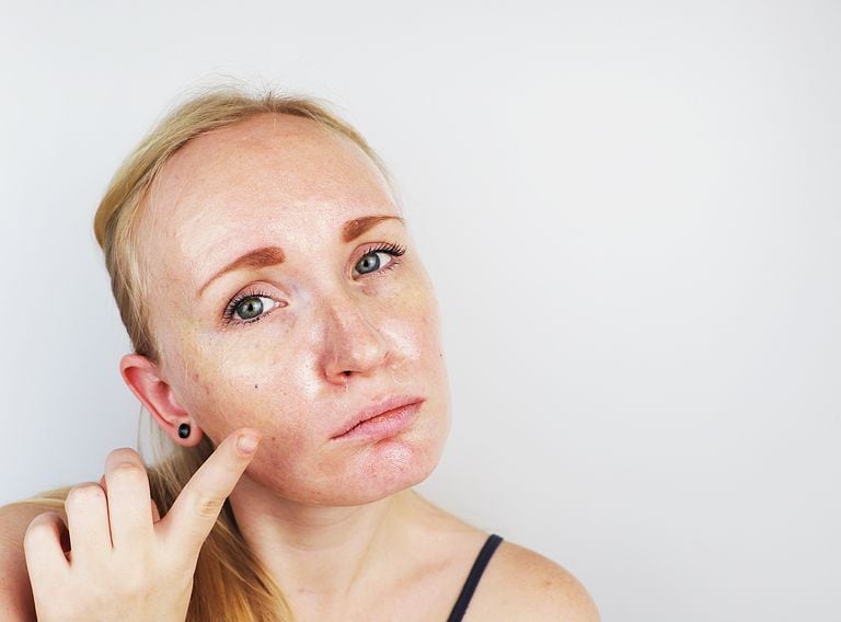 Portrait of a blonde girl with acne, oily skin and pigmentation. Oily and problem skin.